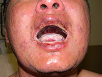 Candidiasis and Stevens-Johnson syndrome in an HIV patient